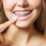 braces-treatment