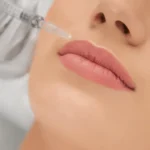 lip-filler