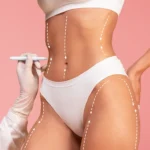 liposuction