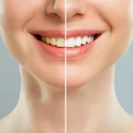 teeth-whitening