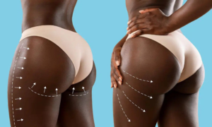 BBL (Brazilian Butt Lift)