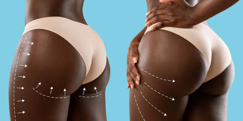 BBL (Brazilian Butt Lift)