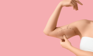 Arm Lift (Brachioplasty)