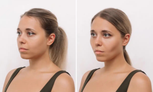 Bichectomy (Buccal Fat Removal)