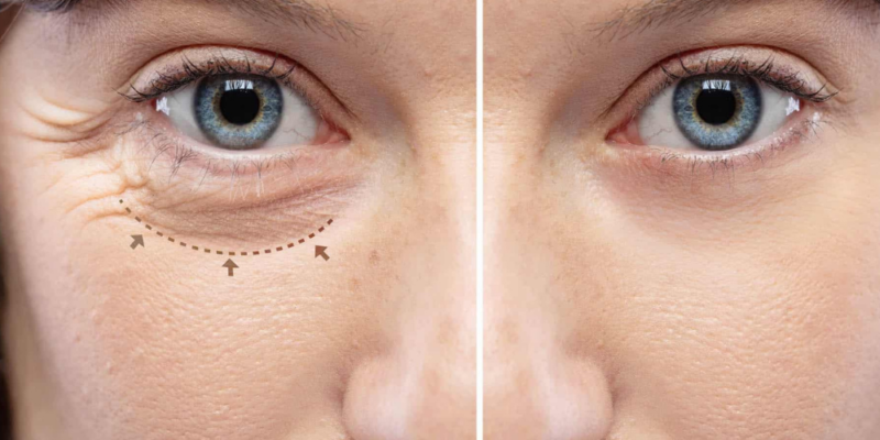 Blepharoplasty (Eyelid Surgery)