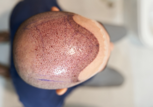 Breast Lift Turkey: Is it Worth it?