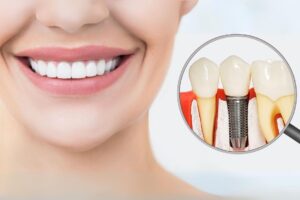 Dental Implants