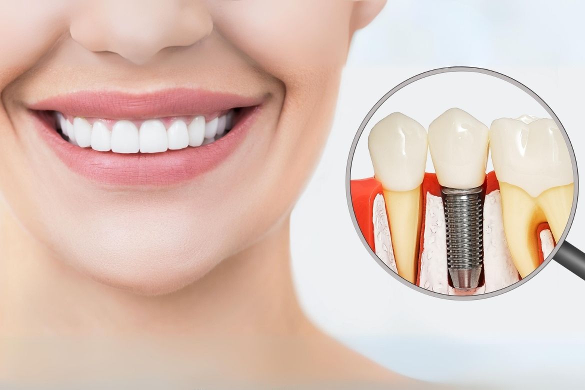Dental Implants