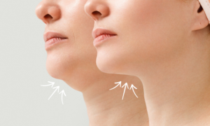 Chin Liposuction