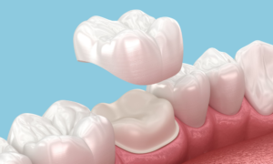 Dental Crowns