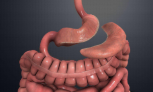 Gastric Sleeve (Sleeve Gastrectomy)