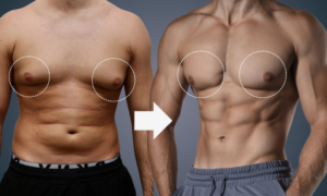Gynecomastia
