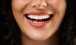 Hollywood Smile (Cosmetic Smile Design)