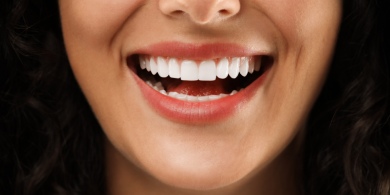 Hollywood Smile (Cosmetic Smile Design)
