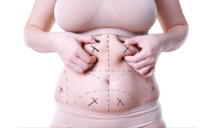 Liposuction