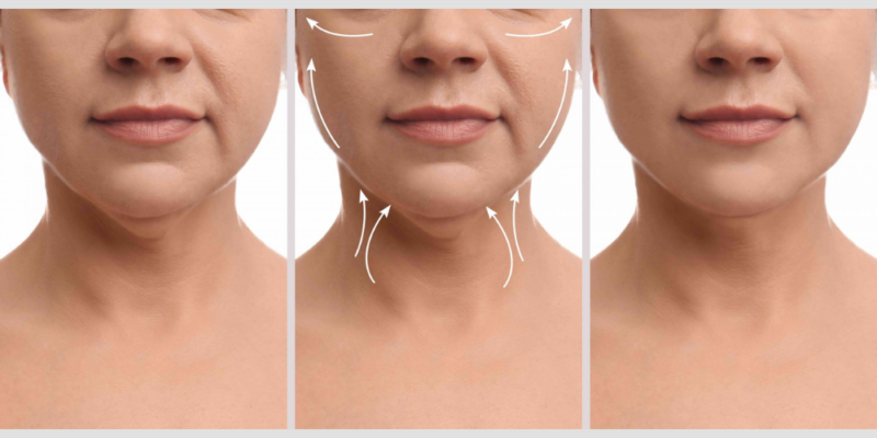 Neck Lift (Lower Rhytidectomy)