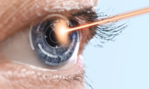 No-Touch Laser (PRK / LASEK)