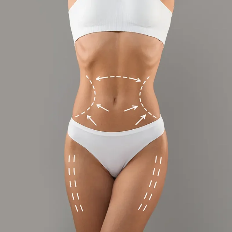 Abdominoplasty